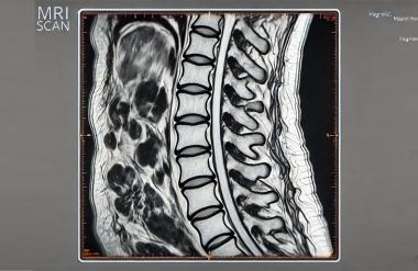 МРТ (магнитно-резонансная томография) позвоночника
