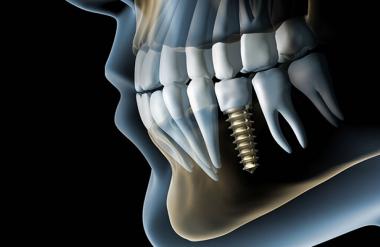 КТ (компьютерная томография) челюсти