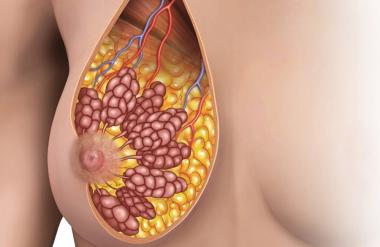 МРТ (магнитно-резонансная томография) молочной железы