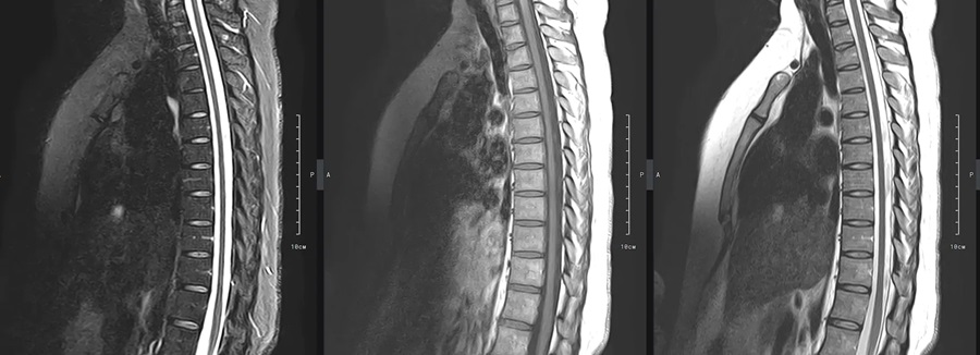 МРТ грудного отдела позвоночника в боковой проекции - снимки