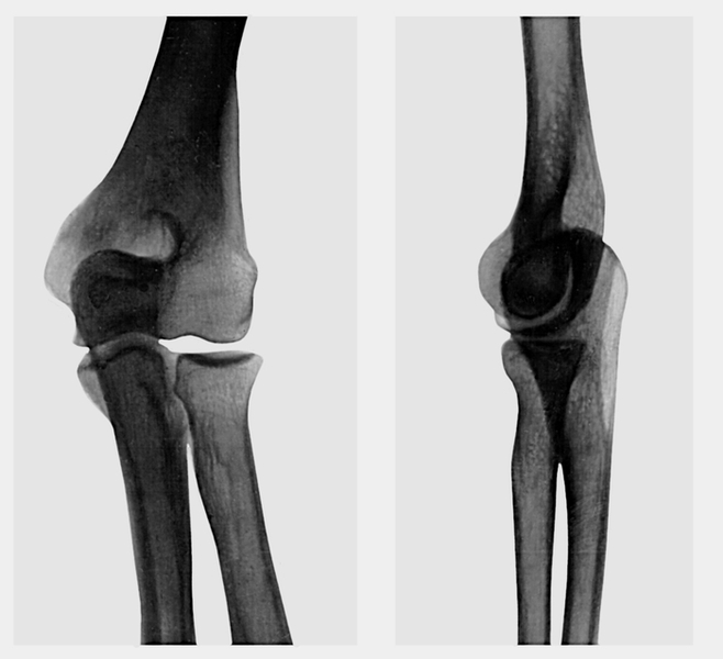 Рентген локтевого сустава - фото