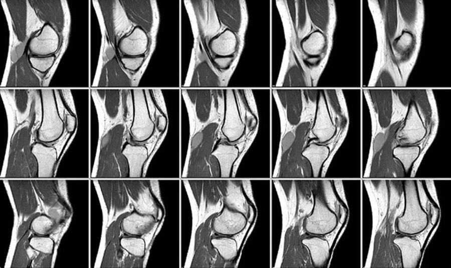 Снимки МРТ коленного сустава.