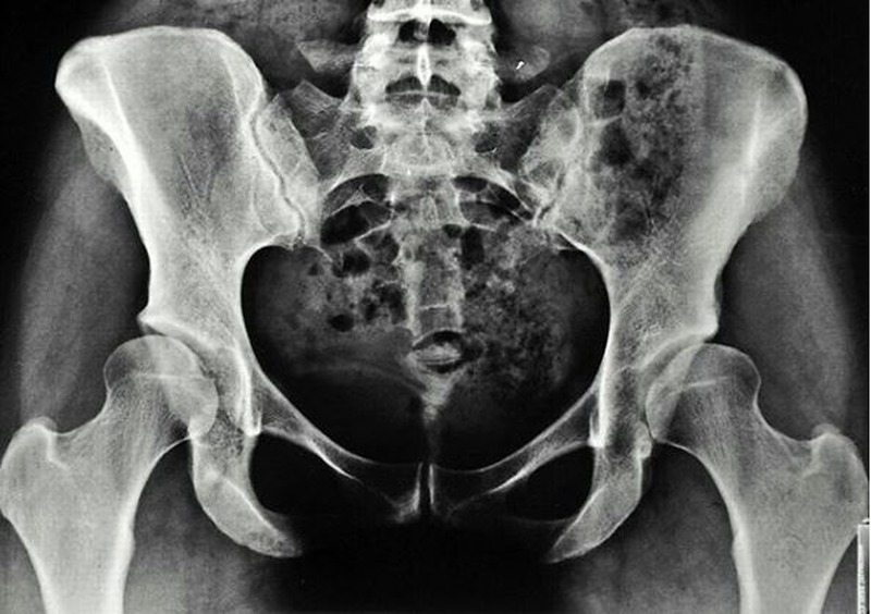 Рентген костей таза - снимки