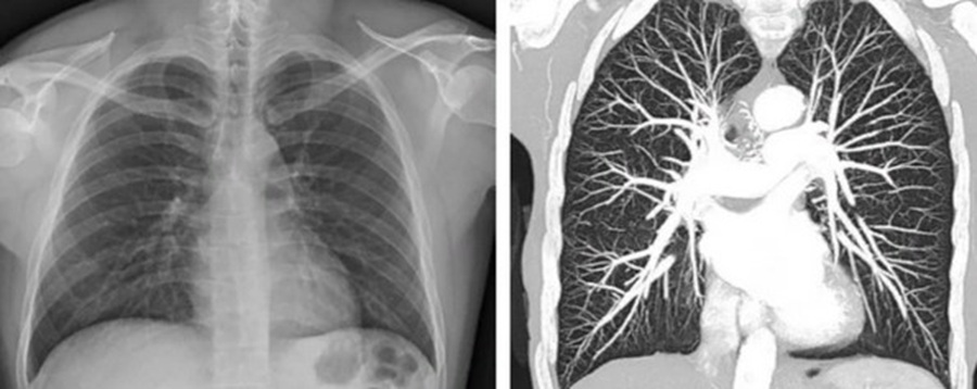 Сравнение снимков КТ и рентгенографии легких.