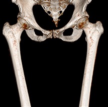 КТ бедренной кости - отличия от рентгена