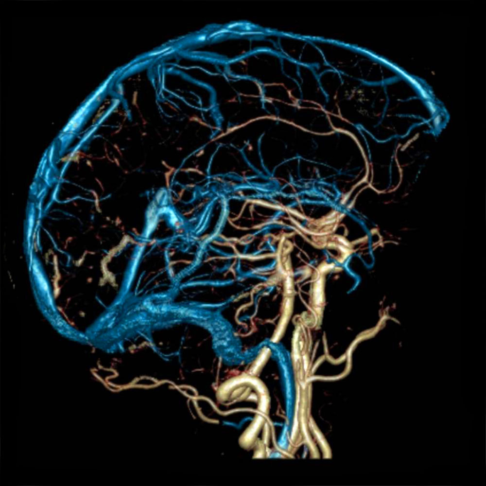 МР-ангиография вен мозга - показания