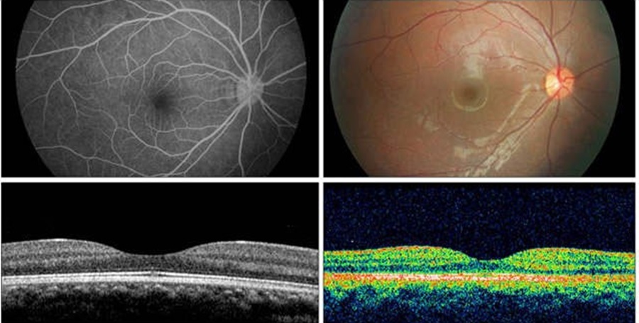 Изображение сетчатки глаза на ОКТ