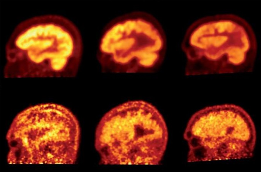 Болезнь Альцгеймера на снимках ПЭТ