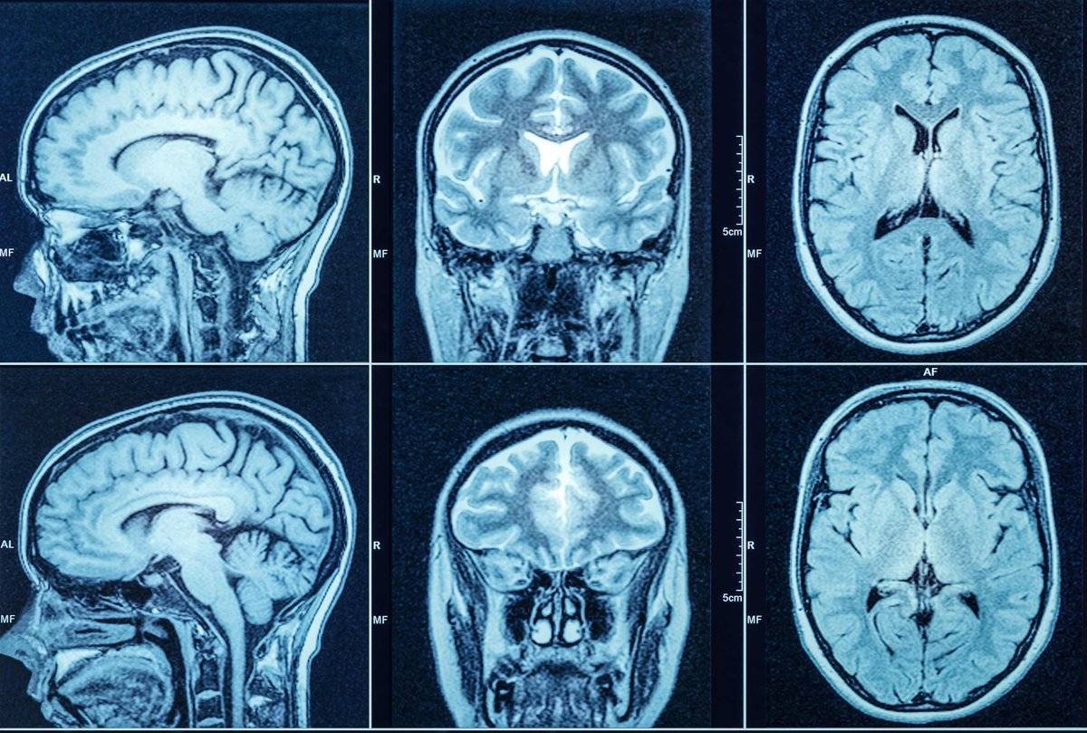 Изображение МРТ головного мозга