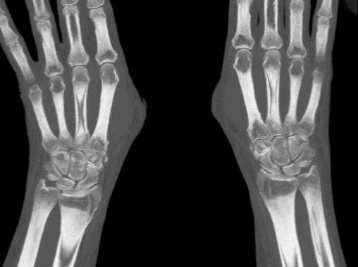 КТ лучезапястного сустава - отличия от рентгена