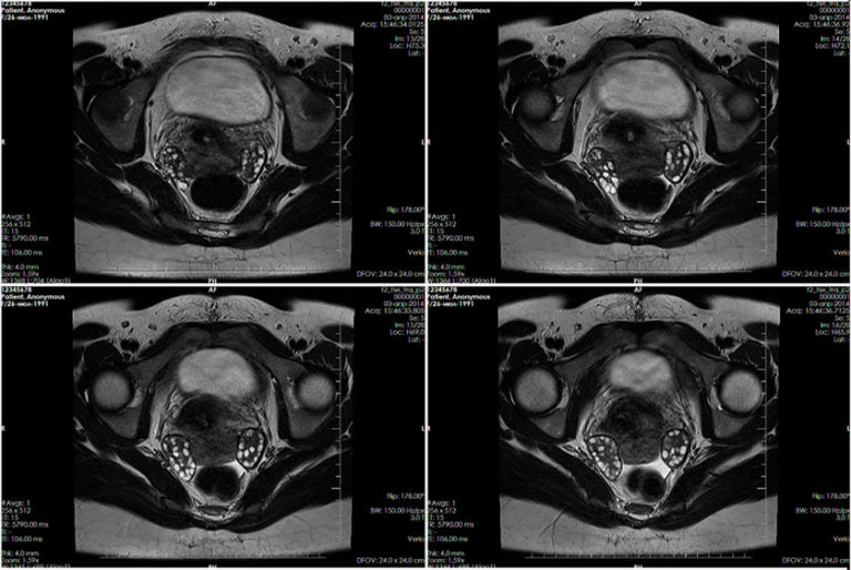 МРТ органов малого таза с контрастом - снимки