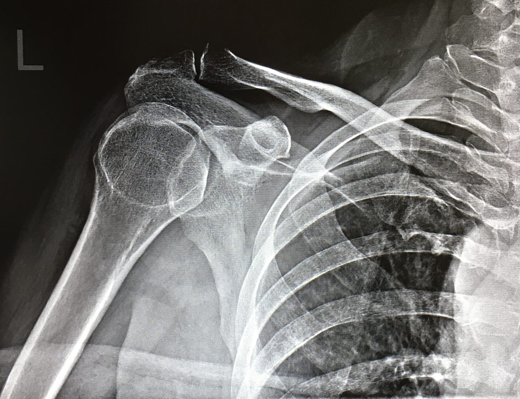 Рентген плечевого сустава - снимки