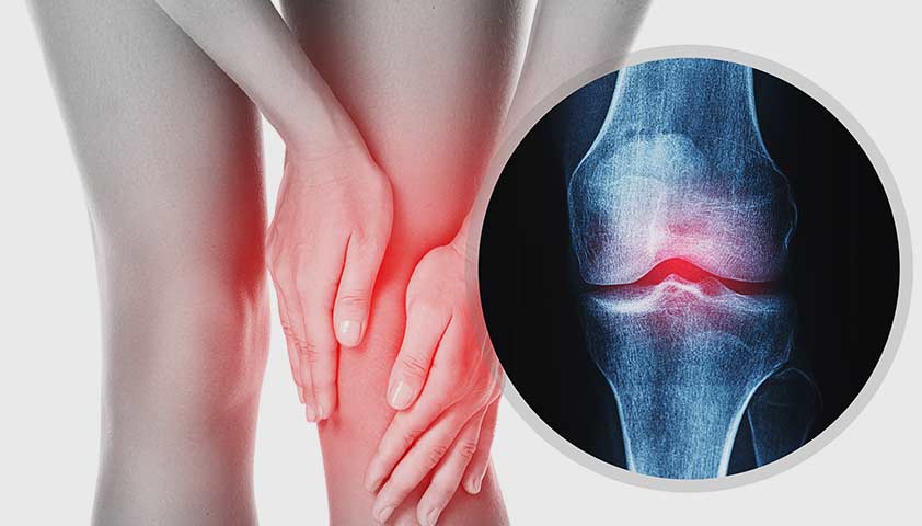 Рентген коленного сустава - показания