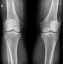 Рентген коленного сустава - что показывают снимки