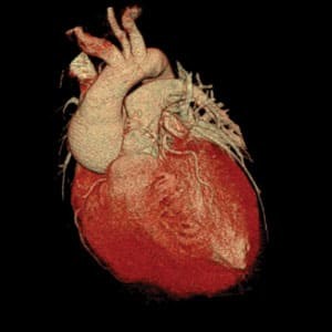 КТ сердца в 3D формате