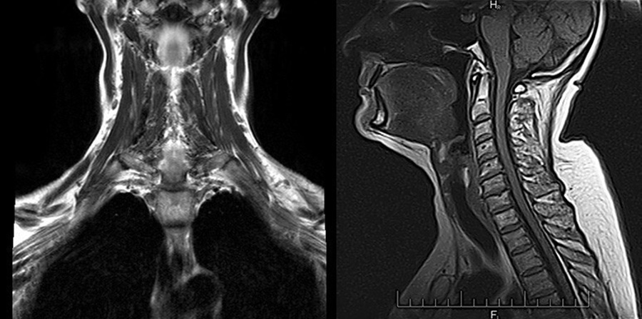 Снимки МРТ шеи.
