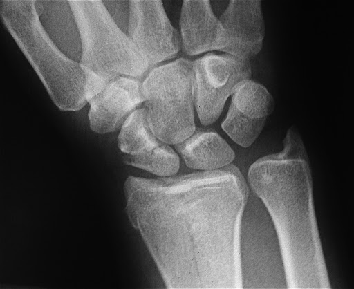 Рентген лучезапястного сустава - снимки