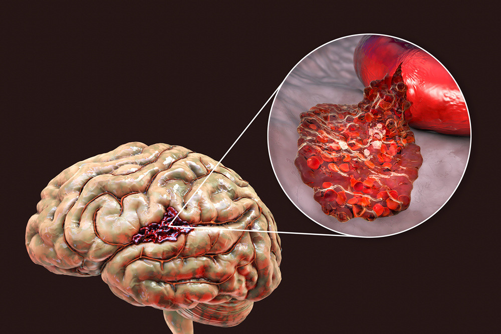 МРТ сосудов головного мозга при инсульте