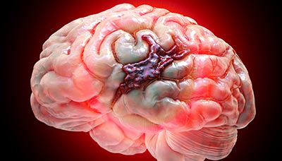 МРТ сосудов головного мозга при тромбозе