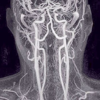 МР-ангиографию сосудов мозга и шеи с контрастом - особенности
