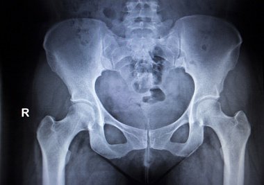 Рентген тазобедренного сустава - показания