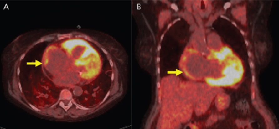 Сердце на снимках ПЭТ
