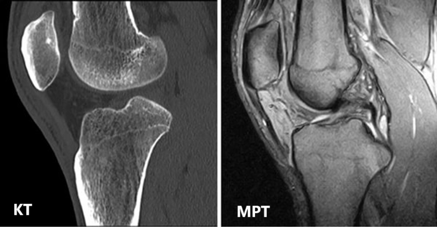 Сравнение снимков КТ и МРТ коленного сустава.