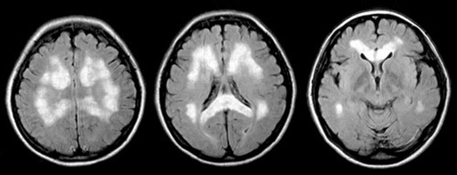 Поражение головного мозга на МРТ