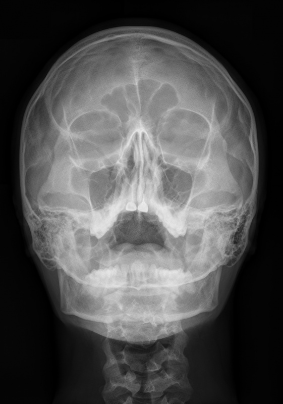 Рентген пазух носа - что показывает исследование