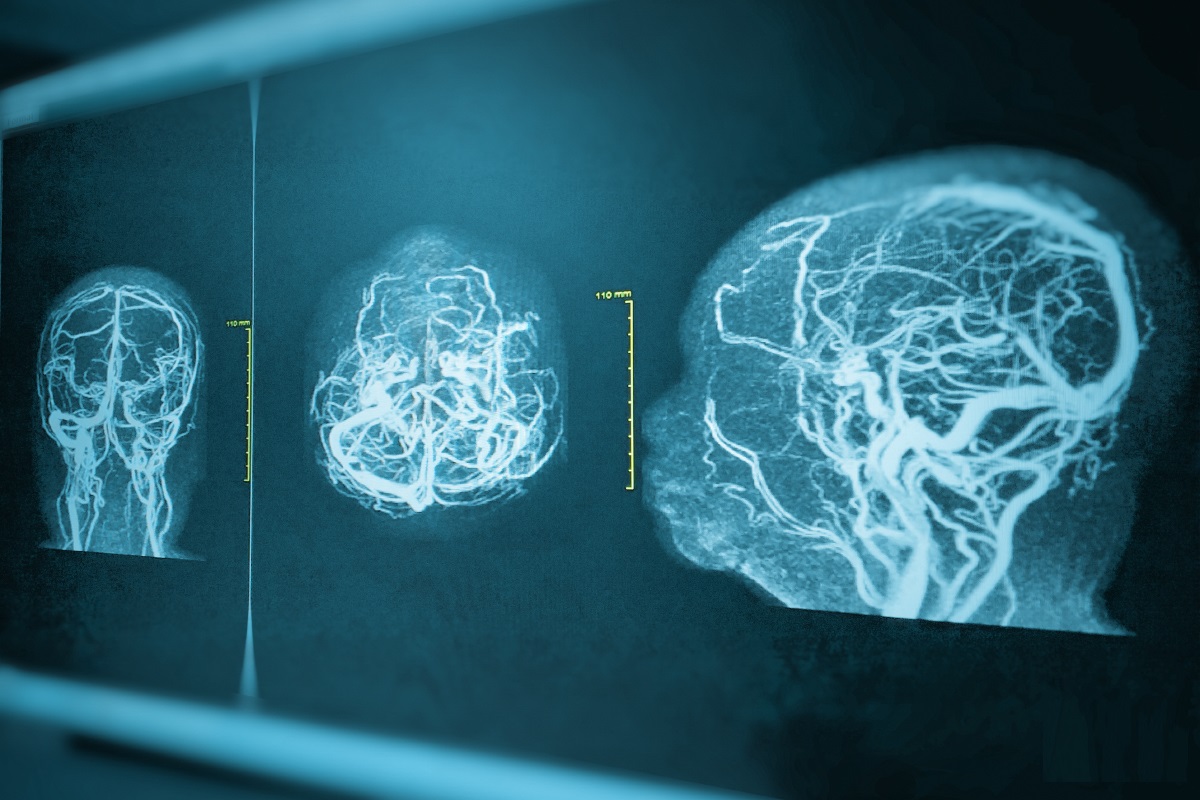 МРТ головного мозга, сосудов головы и шеи - снимки