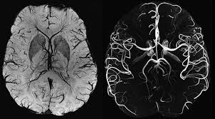 МРТ сосудов головного мозга с контрастом