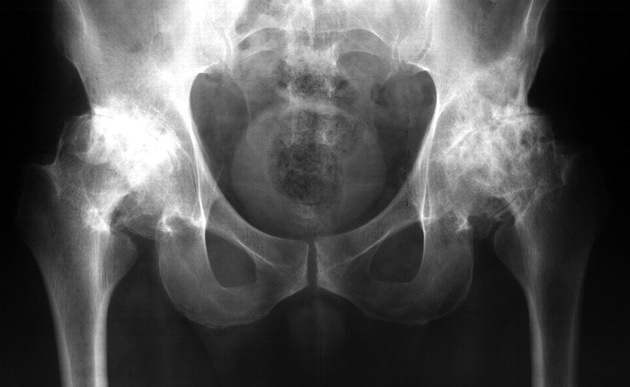 Рентген тазобедренного сустава при коксартрозе - снимки
