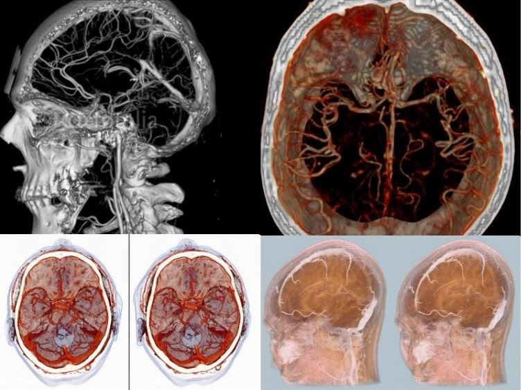 КТ головного мозга с 3D реконструкцией сосудов