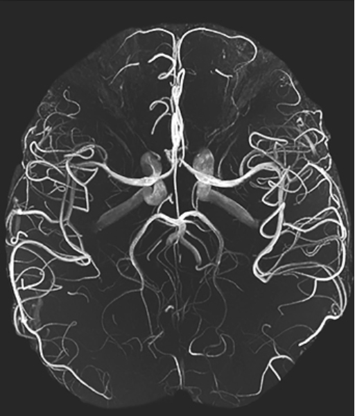 МР-ангиографию вен мозга - снимки