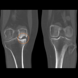Рентген коленного сустава при гонартрозе