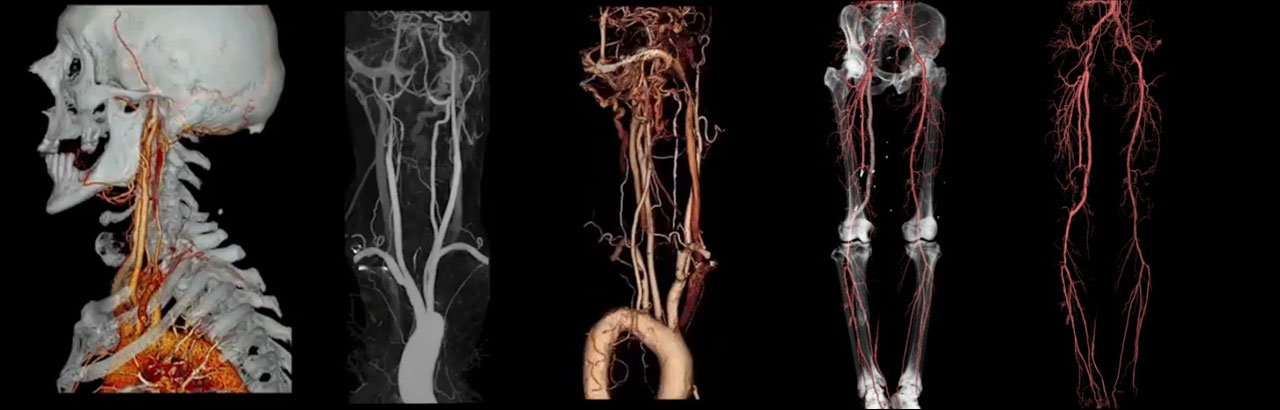 КТ-ангиография сосудов шеи, таза и нижних конечностей