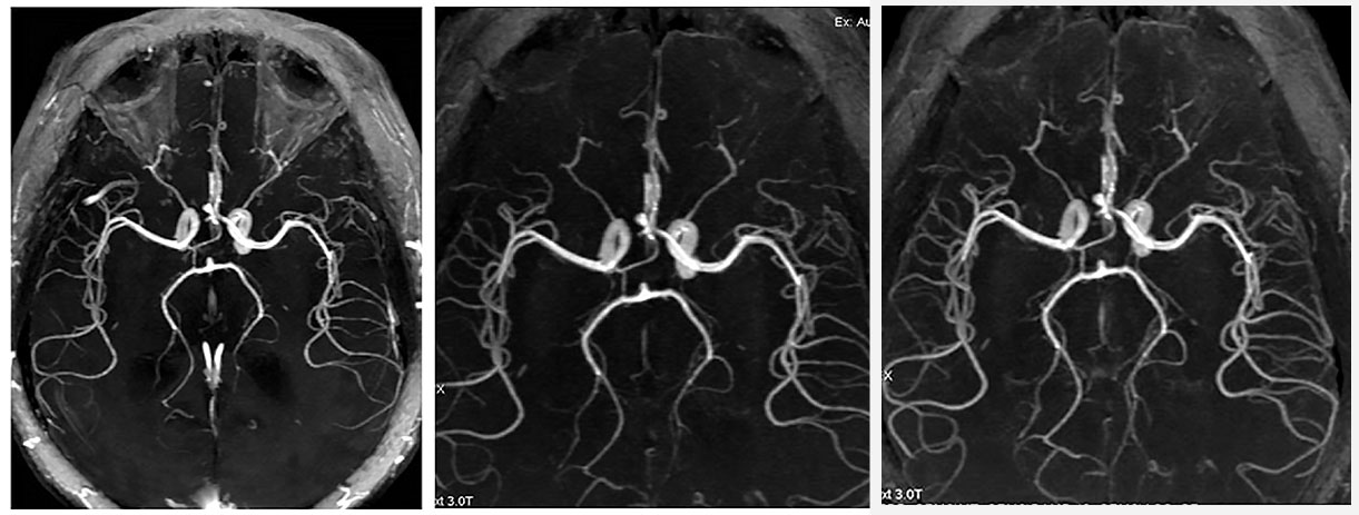 МР-ангиография сосудов головного мозга - снимки