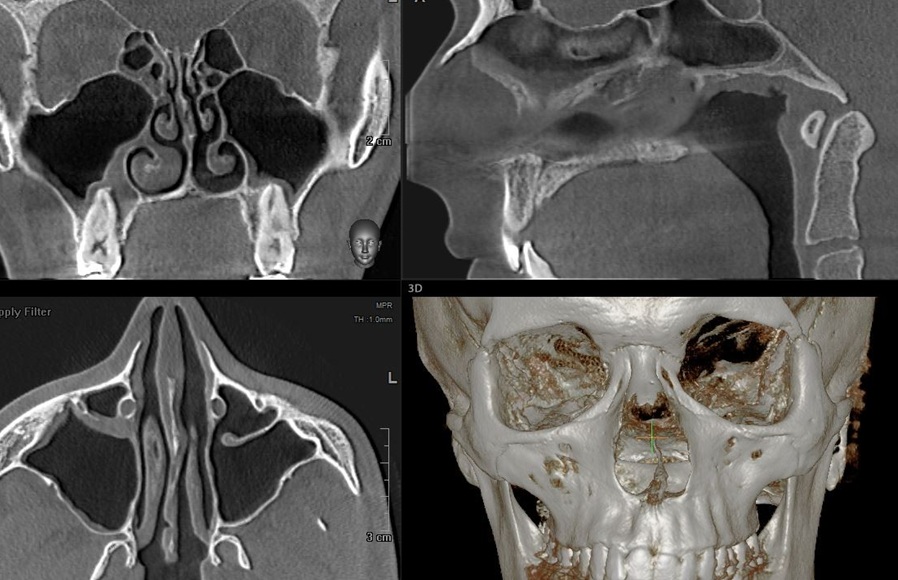 КТ пазу носа с 3D реконструкцией