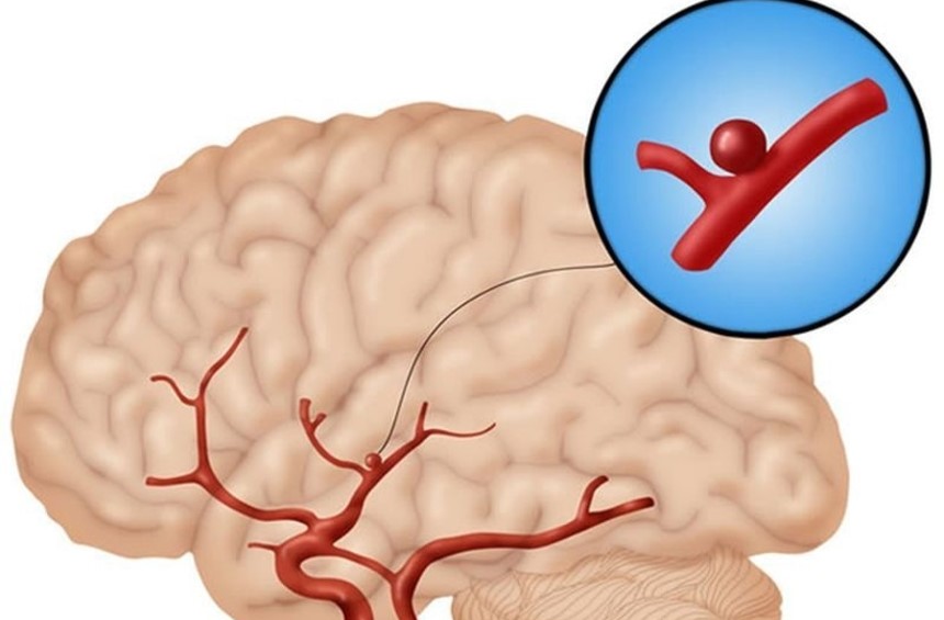 Аневризма сосуда головного мозга