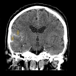 КТ сосудов головного мозга при субарахноидальном кровоизлиянии