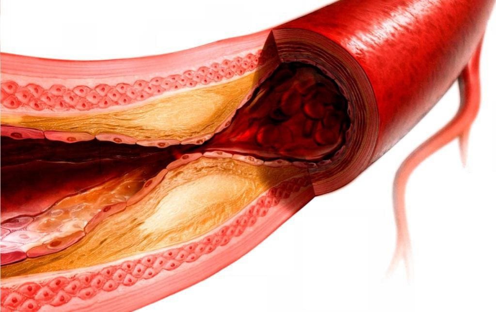 Атеросклероз сосуда в разрезе