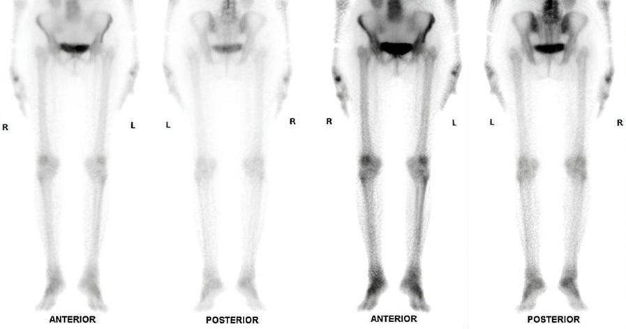 Остеосцинтиграфия таза и нижних конечностей.