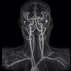 МР-ангиографию сосудов мозга и шеи - снимки