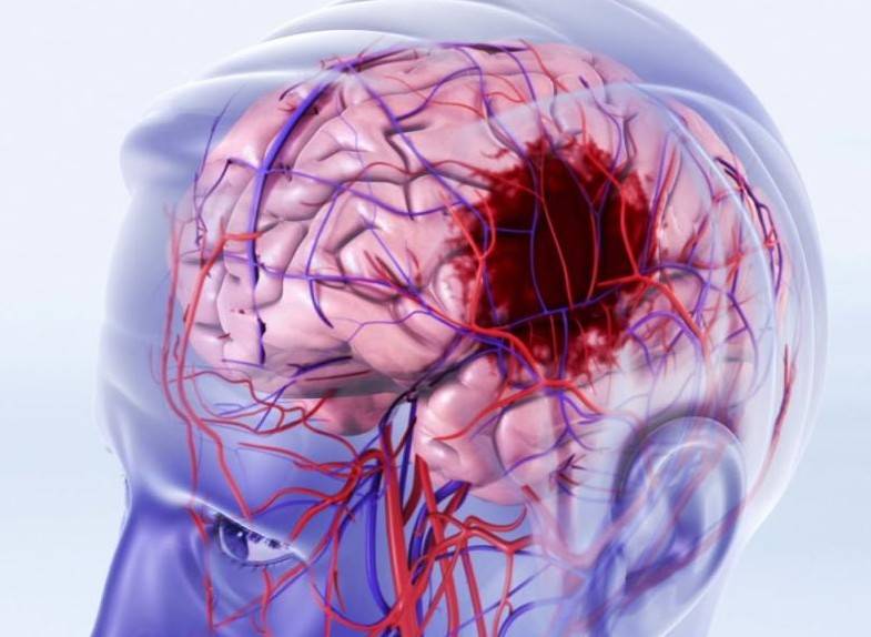КТ головного мозга при геморрагическом инсульте