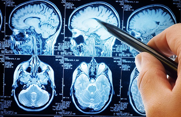 Заболевания головного мозга на МРТ - снимки