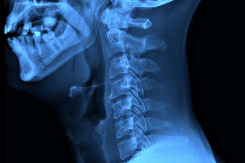 Рентген шейного отдела позвоночника - снимки