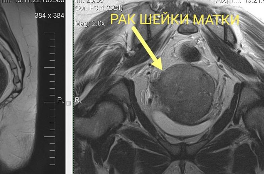 Рак шейки матки на снимке МРТ