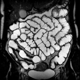 Гидро-МРТ кишечника - снимки