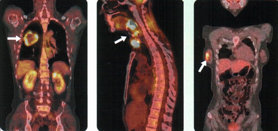 Раковые опухоли на снимках ПЭТ