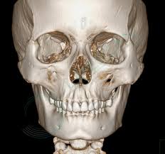 КТ костей лицевого черепа - снимки